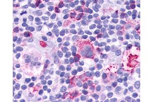 Anti-Leukotriene B4 Receptor / BLT1 antibody IHC of human Lymph Node, Hodgkins Lymphoma. (Leukotriene B4 Receptor/BLT 抗体  (C-Term))