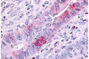 Anti-MAP3K9 antibody  ABIN1049037 IHC staining of human colon cancer. (MAP3K9 抗体  (Internal Region))