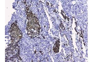 IHC analysis of Cytokeratin 19 using anti-Cytokeratin 19 antibody (ABIN3043288). (Cytokeratin 19 抗体  (C-Term))