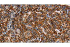 Immunohistochemistry of paraffin-embedded Human thyroid cancer using MRPL39 Polyclonal Antibody at dilution of 1:45 (MRPL39 抗体)