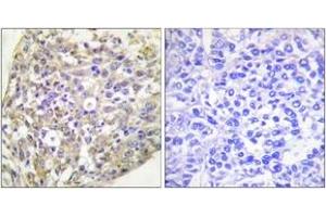 Immunohistochemistry analysis of paraffin-embedded human breast carcinoma, using HSP90B (Phospho-Ser254) Antibody. (HSP90AB1 抗体  (pSer254))