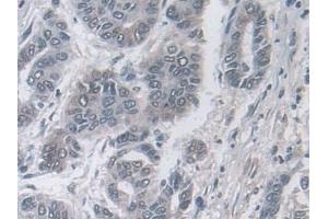 Detection of Ub in Human Liver cancer Tissue using Polyclonal Antibody to Ubiquitin (Ub)