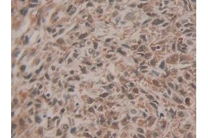 Detection of EZH2 in Human Lung cancer Tissue using Polyclonal Antibody to Enhancer Of Zeste Homolog 2 (EZH2) (EZH2 抗体  (AA 51-285))