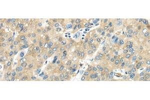 Immunohistochemistry of paraffin-embedded Human liver cancer tissue using VPS4A Polyclonal Antibody at dilution 1:40 (VPS4A 抗体)