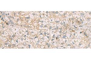 Immunohistochemistry of paraffin-embedded Human liver cancer tissue using SLC30A6 Polyclonal Antibody at dilution of 1:70(x200) (SLC30A6 抗体)