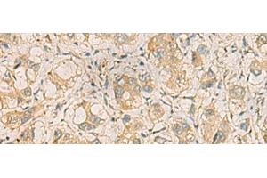 Immunohistochemistry of paraffin-embedded Human liver cancer tissue using ZDHHC3 Polyclonal Antibody at dilution of 1:35(x200) (ZDHHC3 抗体)