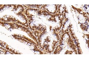 Detection of GAPDH in Human Colorectal cancer Tissue using Anti-Glyceraldehyde-3-Phosphate Dehydrogenase (GAPDH) Monoclonal Antibody (GAPDH 抗体  (AA 2-148))