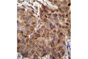mmunohistochemistry analysis in human breast carcinoma (formalin-fixed, paraffin-embedded) using Sorting nexin-24 (SNX24)  Antibody (N-term), followed by peroxidase conjugation of the secondary antibody and DAB staining. (SNX24 抗体  (N-Term))