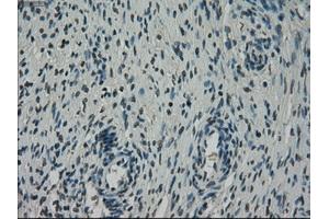 Immunohistochemical staining of paraffin-embedded Adenocarcinoma of breast tissue using anti-NEK6 mouse monoclonal antibody. (NEK6 抗体)