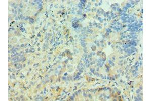 Immunohistochemistry of paraffin-embedded human lung cancer using ABIN7150969 at dilution of 1:100