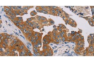 Immunohistochemistry of paraffin-embedded Human cervical cancer tissue using MBNL3 Polyclonal Antibody at dilution 1:30 (MBNL3 抗体)