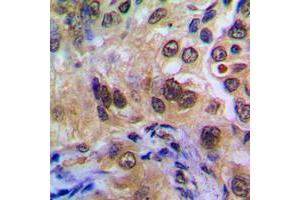 Immunohistochemical analysis of POTEA staining in human breast cancer formalin fixed paraffin embedded tissue section. (POTEA 抗体  (C-Term))