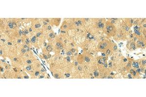 Immunohistochemistry of paraffin-embedded Human liver cancer using TRIM10 Polyclonal Antibody at dilution of 1/35 (TRIM10 抗体)