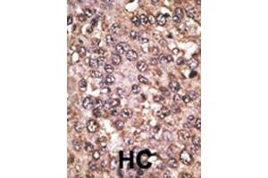 Formalin-fixed and paraffin-embedded human cancer tissue reacted with the primary antibody, which was peroxidase-conjugated to the secondary antibody, followed by DAB staining. (SIRT5 抗体  (C-Term))