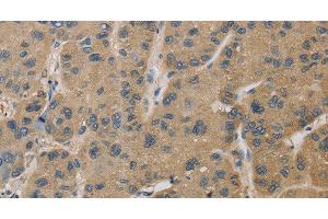 Immunohistochemistry of paraffin-embedded Human liver cancer tissue using TBXAS1 Polyclonal Antibody at dilution 1:30 (TBXAS1 抗体)
