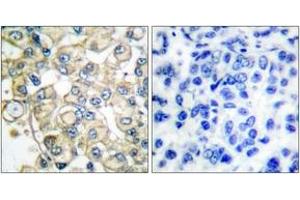 Immunohistochemistry analysis of paraffin-embedded human breast carcinoma tissue, using FGFR1 Oncogene Partner Antibody. (FGFR1OP 抗体  (AA 341-390))