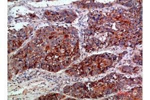 Immunohistochemical analysis of paraffin-embedded human-lung-cancer, antibody was diluted at 1:200 (MLL/KMT2A 抗体  (AA 3850-3900))