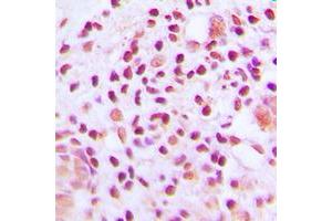 Immunohistochemical analysis of MUTYH staining in human lung cancer formalin fixed paraffin embedded tissue section. (MUTYH 抗体  (Center))
