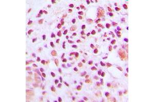 Immunohistochemical analysis of MUTYH staining in human lung cancer formalin fixed paraffin embedded tissue section.