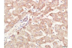 Paraformaldehyde-fixed, paraffin embedded human liver carcinoma tissue, Antigen retrieval by boiling in sodium citrate buffer(pH6) for 15min, Block endogenous peroxidase by 3% hydrogen peroxide for 30 minutes, Blocking buffer (normal goat serum) at 37°C for 20min, Antibody incubation with Rabbit Anti-ALDH1 Polyclonal Antibody, Unconjugated  at 1:400 overnight at 4°C, followed by a conjugated secondary and DAB staining (ALDH1A1 抗体  (AA 201-300))