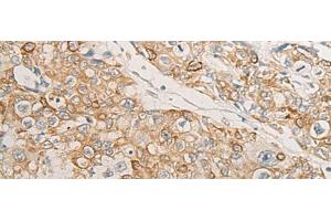 Immunohistochemistry of paraffin-embedded Human prost at e cancer tissue using HLA-DMB Polyclonal Antibody at dilution of 1:40(x200) (HLA-DMB 抗体)