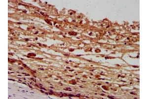 IHC image of ABIN7162587 diluted at 1:400 and staining in paraffin-embedded human melanoma performed on a Leica BondTM system. (Pannexin 2 抗体  (AA 370-470))