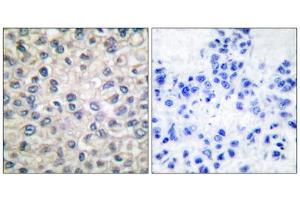 Immunohistochemical analysis of paraffin-embedded human breast carcinoma tissue, using Catenin- alpha antibody. (CTNNA1 抗体  (C-Term))