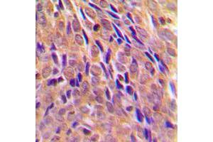 Immunohistochemical analysis of IKK alpha (pT23) staining in human breast cancer formalin fixed paraffin embedded tissue section.