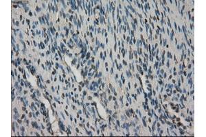 Immunohistochemical staining of paraffin-embedded Adenocarcinoma of breast tissue using anti-STK39 mouse monoclonal antibody. (STK39 抗体)