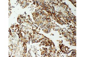 Anti-AIF antibody, IHC(P) IHC(P): Human Lung Cancer Tissue