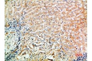 Immunohistochemical analysis of paraffin-embedded human-liver-cancer, antibody was diluted at 1:200 (WISP3 抗体  (AA 1-50))