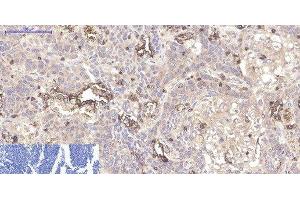 Immunohistochemistry of paraffin-embedded Human lung cancer tissue using CD45 Monoclonal Antibody at dilution of 1:200. (CD45 抗体)