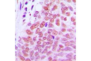 Immunohistochemical analysis of RXR gamma staining in human breast cancer formalin fixed paraffin embedded tissue section. (Retinoid X Receptor gamma 抗体  (Center))
