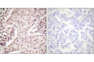 Immunohistochemistry analysis of paraffin-embedded human breast carcinoma, using Chk2 (Ab-387) Antibody. (CHEK2 抗体  (AA 361-410))