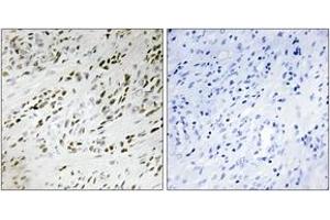 Immunohistochemistry analysis of paraffin-embedded human prostate carcinoma tissue, using TSH2 Antibody. (THNSL2 抗体  (AA 811-860))