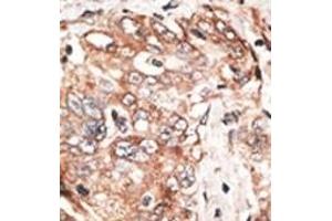 Formalin-fixed and paraffin-embedded human cancer tissue reacted with the primary antibody, which was peroxidase-conjugated to the secondary antibody, followed by DAB staining. (TPX2 抗体  (AA 350-382))