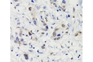 Immunohistochemistry (Paraffin-embedded Sections) (IHC (p)) image for anti-Signal Transducer and Activator of Transcription 3 (Acute-Phase Response Factor) (STAT3) (pSer727) antibody (ABIN7265216)