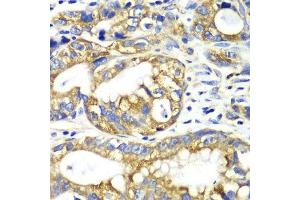 Immunohistochemistry of paraffin-embedded human gastric cancer using AK2 antibody. (Adenylate Kinase 2 抗体  (AA 1-232))