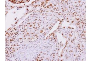 IHC-P Image Carboxypeptidase E antibody [N2C2], Internal detects Carboxypeptidase E protein at nucleus on human breast cancer by immunohistochemical analysis.