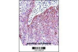 KRT6B Antibody immunohistochemistry analysis in formalin fixed and paraffin embedded human cervical carcinoma followed by peroxidase conjugation of the secondary antibody and DAB staining. (Keratin 6B 抗体  (AA 207-236))