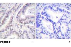 Immunohistochemical analysis of paraffin-embedded human lung carcinoma tissue using CDC6 polyclonal antibody . (CDC6 抗体)