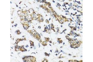 Immunohistochemistry of paraffin-embedded Human breast cancer using DHRS2 Polyclonal Antibody at dilution of 1:100 (40x lens). (DHRS2 抗体)