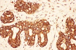 Anti-Src Picoband antibody,  IHC(P): Human Mammary Cancer Tissue (Src 抗体  (AA 2-368))
