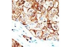 Formalin-fixed and paraffin-embedded human cancer tissue reacted with the primary antibody, which was peroxidase-conjugated to the secondary antibody, followed by AEC staining. (Ubiquilin 1 抗体  (AA 296-326))