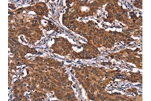 The image on the left is immunohistochemistry of paraffin-embedded Human gastric cancer tissue using ABIN7191188(KCNJ9 Antibody) at dilution 1/15, on the right is treated with synthetic peptide. (KCNJ9 抗体)