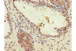 Immunohistochemistry of paraffin-embedded human prostate cancer using ABIN7176555 at dilution of 1:100 (ZNF844 抗体  (AA 1-300))