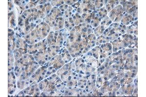 Immunohistochemical staining of paraffin-embedded Adenocarcinoma of Human colon tissue using anti-SNX9 mouse monoclonal antibody.