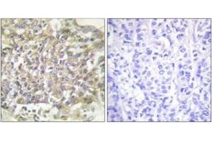 Immunohistochemistry analysis of paraffin-embedded human breast carcinoma tissue, using Shc (Ab-349) Antibody. (SHC1 抗体  (AA 315-364))
