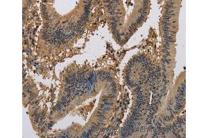 Immunohistochemistry of Human liver cancer using KCNA7 Polyclonal Antibody at dilution of 1:40 (KCNA7 抗体)