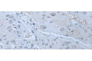 Immunohistochemistry of paraffin-embedded Human esophagus cancer tissue using HUWE1 Polyclonal Antibody at dilution of 1:30(x200) (HUWE1 抗体)
